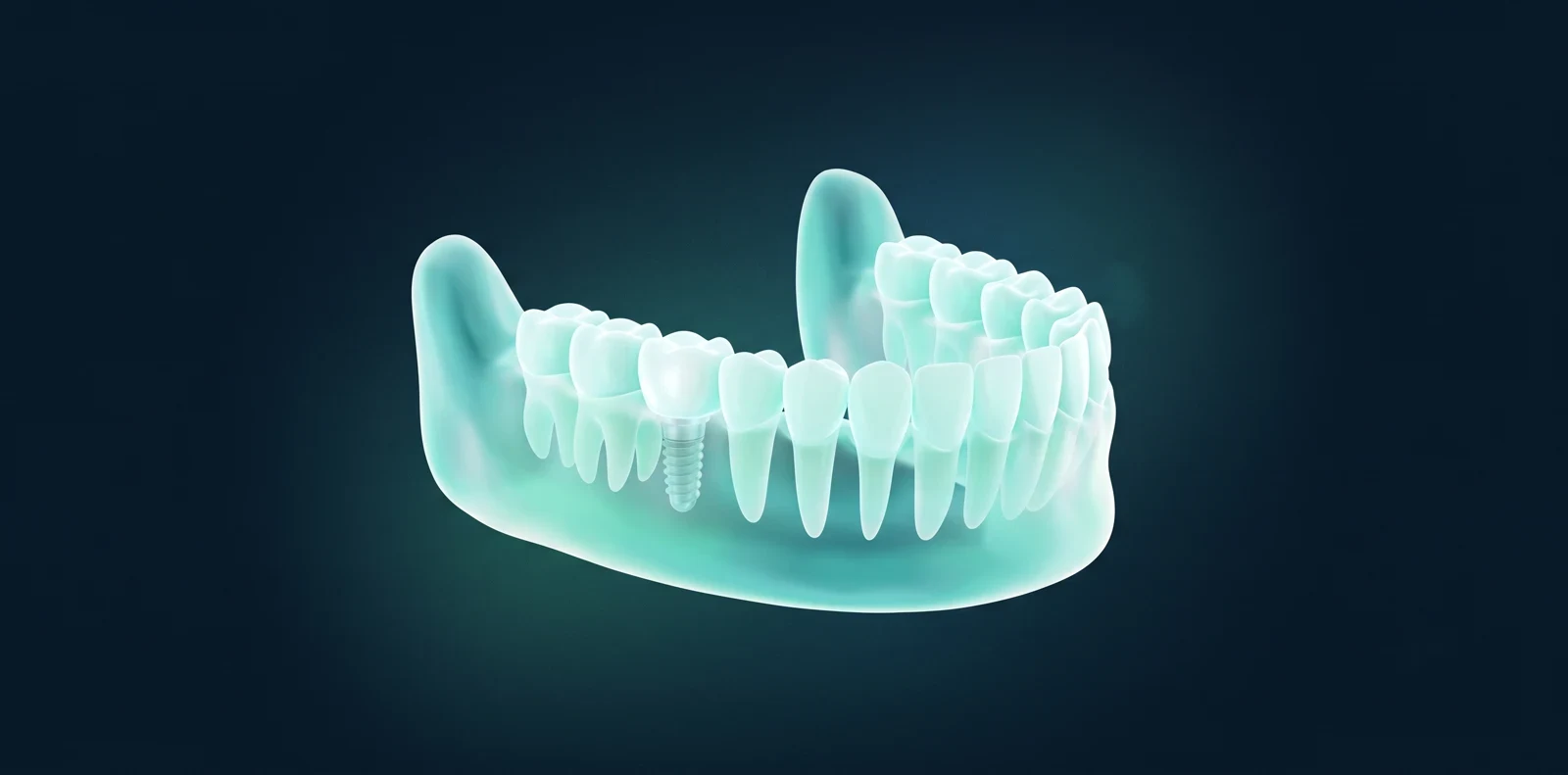 3D-модель для планирования имплантации